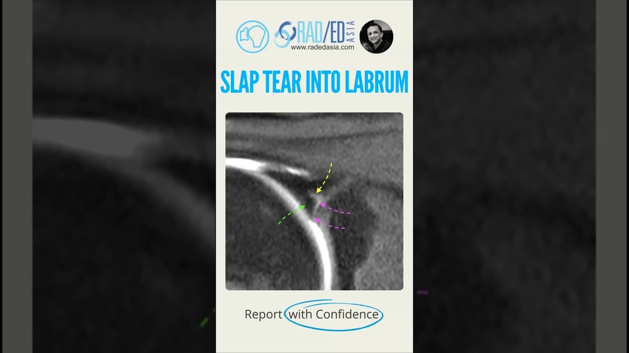 Slap tear vs sublabral recess #Shorts