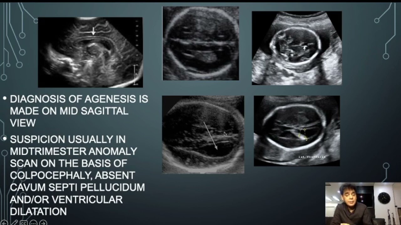 PITFALLS IN DIAGNOSIS OF AGENESIS OF CORPUS CALLOSUM