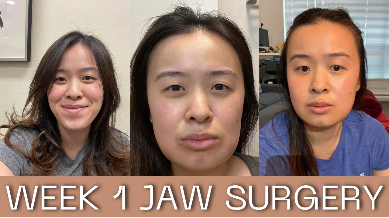 1 Week After Lower Jaw Surgery (LJS) | Swelling & Recovery Update