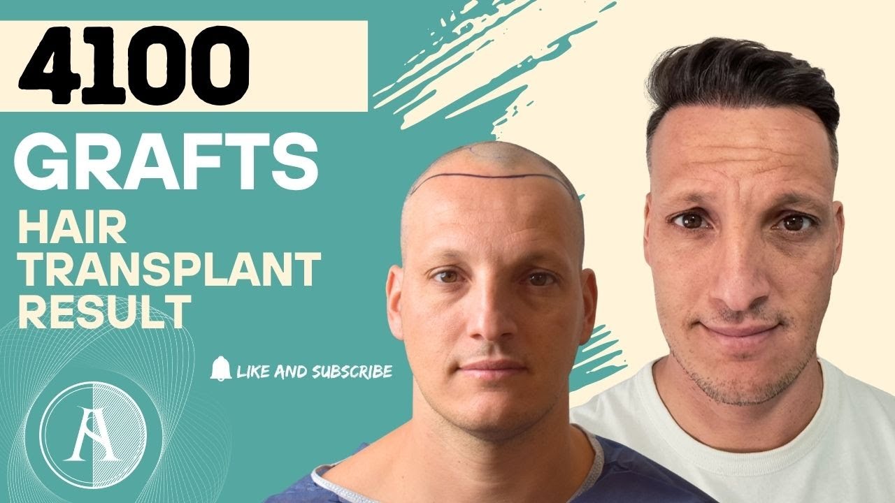 4100 GRAFTS | Norwood 3V FUE Hair Transplant Turkey| 4100 FOLÍCULOS | Norwood 3V Injerto Capilar FUE