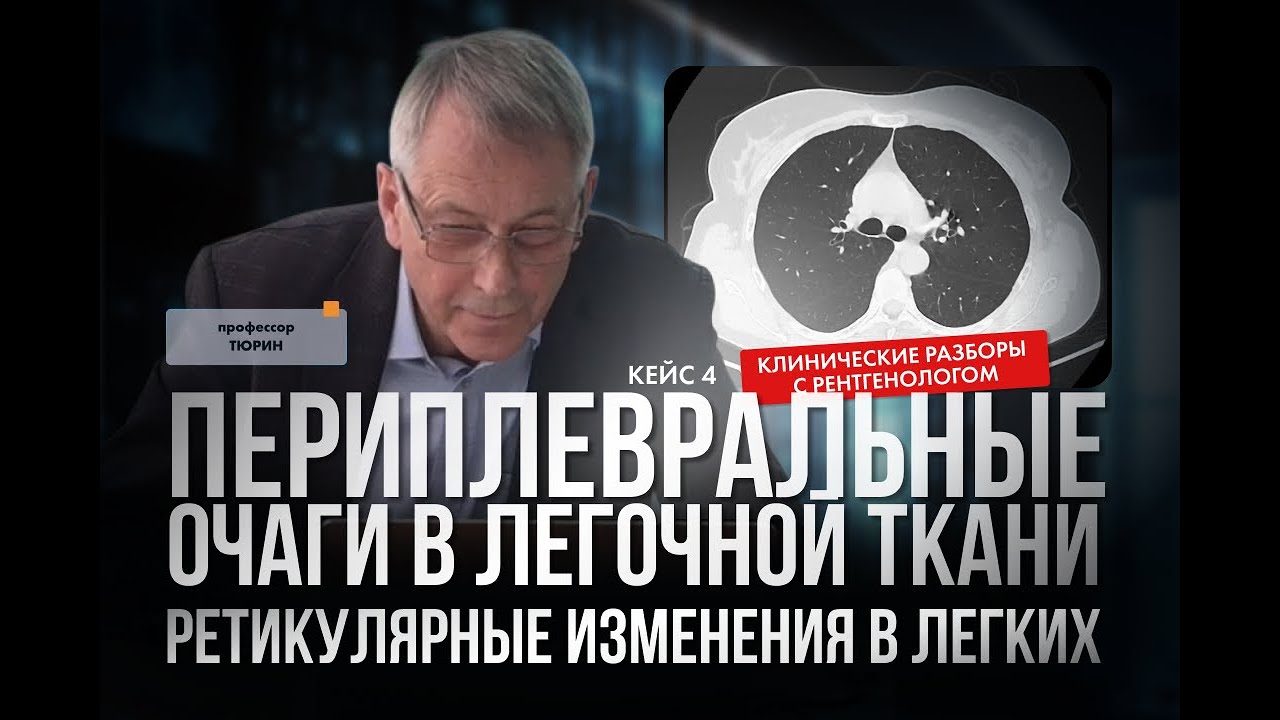 Клинические разборы с рентгенологом. Ретикулярные изменения в легких. Периплевральные очаги