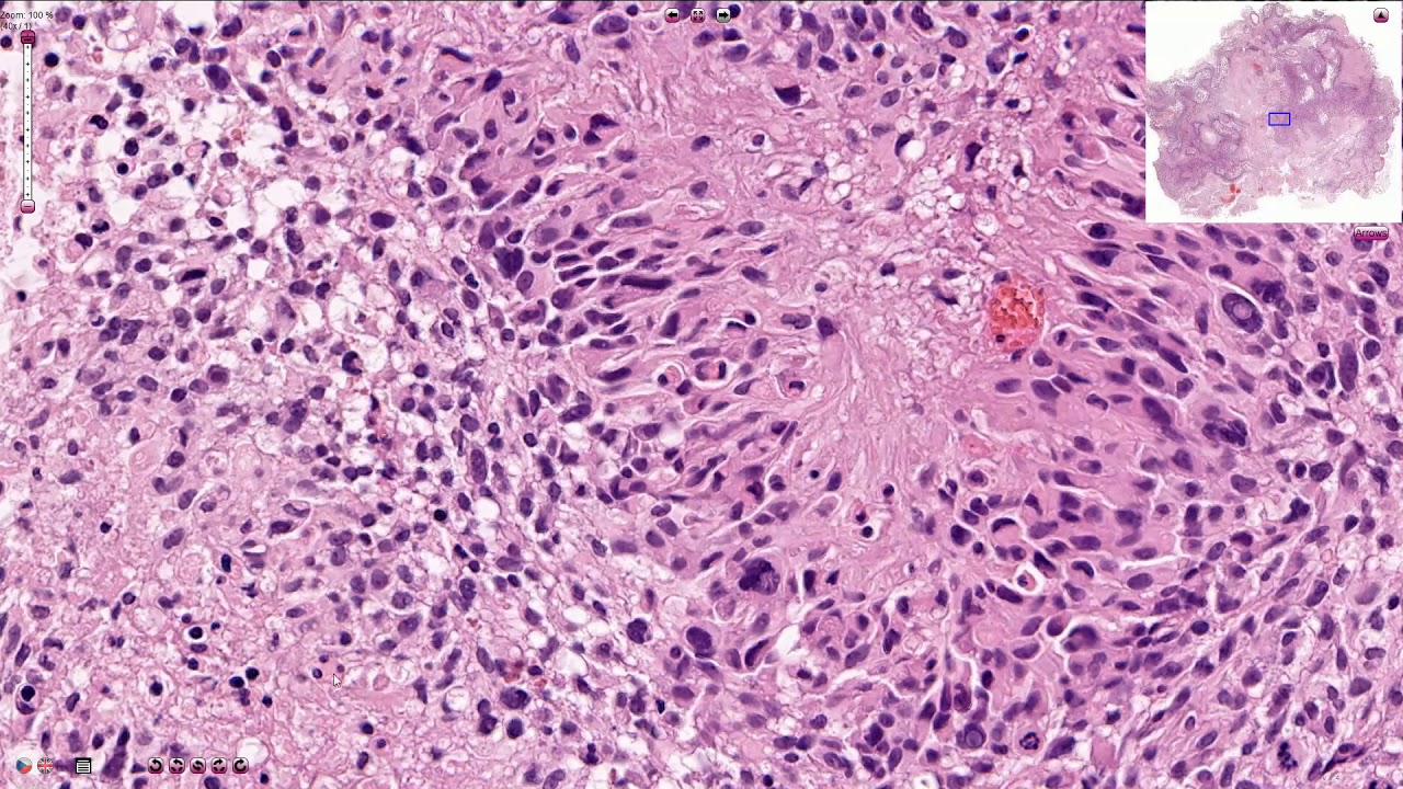 Glioblastoma - Histopathology