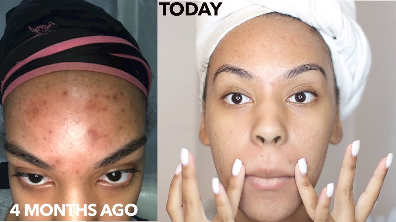 How to Use a Derma Roller to get rid of Acne Scars, Dark spot, Hyperpigmenation