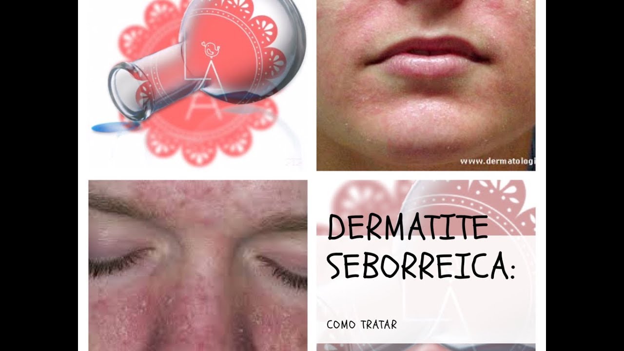 Dermatite Seborreica Facial: Como Tratar
