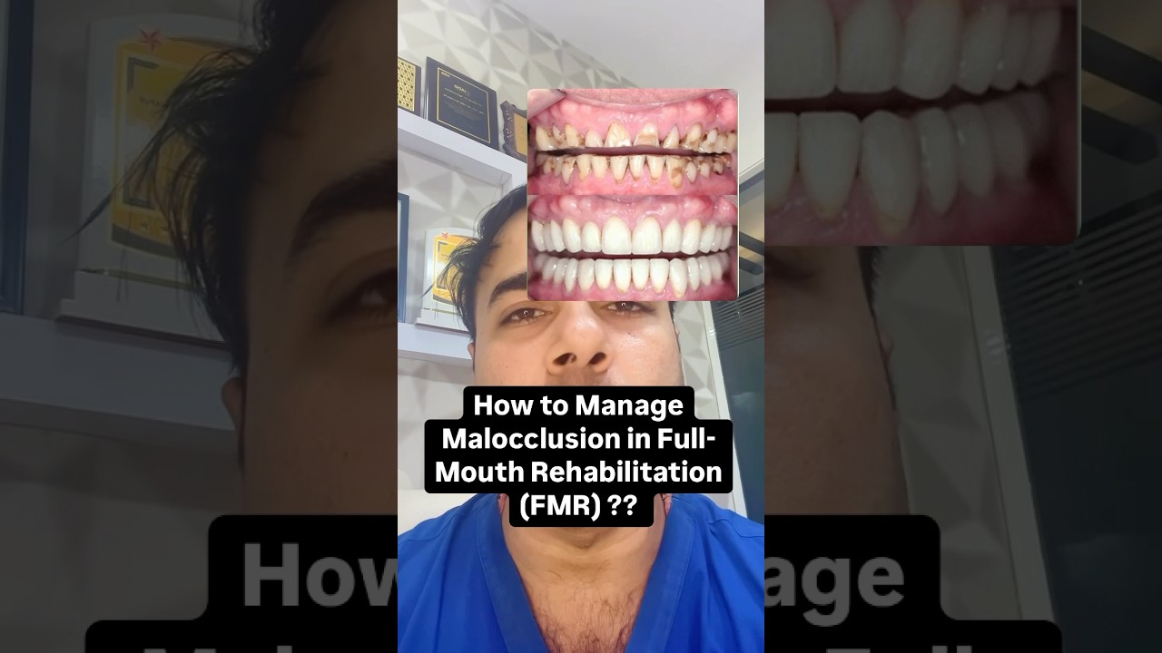 Malocclusion in FMR? Prosthodontist&rsquo;s Step-by-Step Guide! #dentalshorts #dentaltips #fullmouthrehab