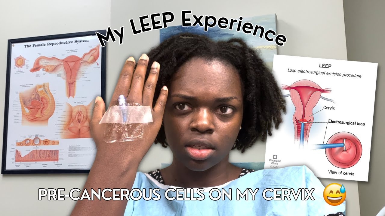 They scraped my cervix with a hot wire | LEEP procedure vlog