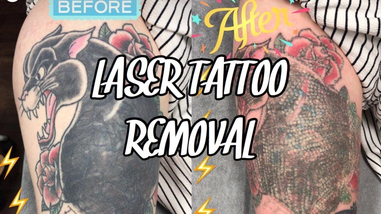 Laser Tattoo Removal Pt 2 | No Numbing Cream | Does It Hurt More????