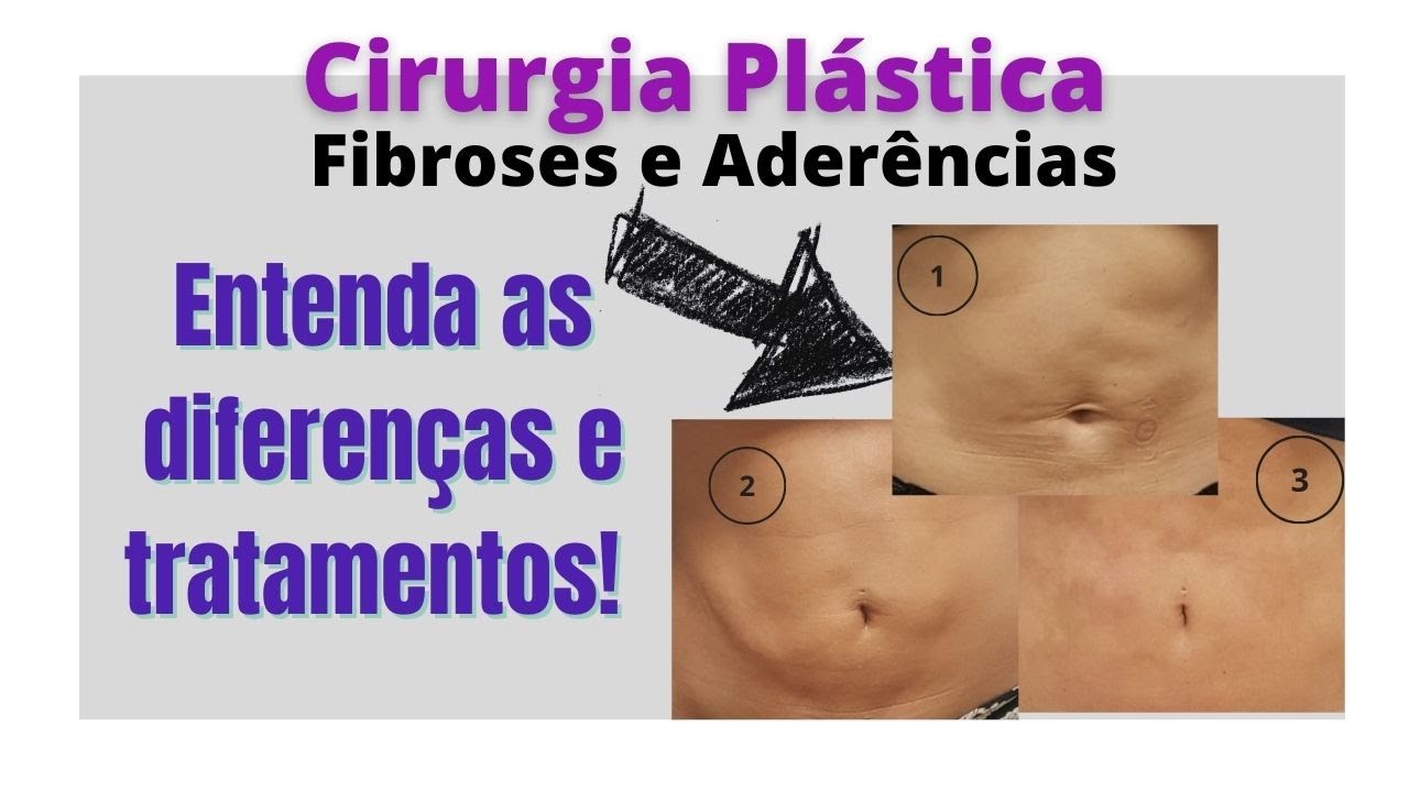 Fibroses e Aderências pós lipo, abdominoplastia: o que são e como melhorar?
