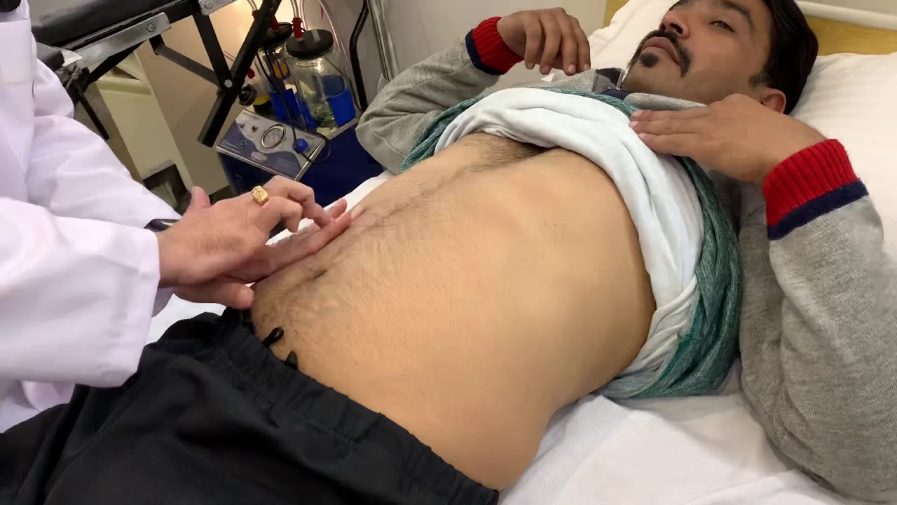 Ascites examination | Liver | Dr Arvind Kumar