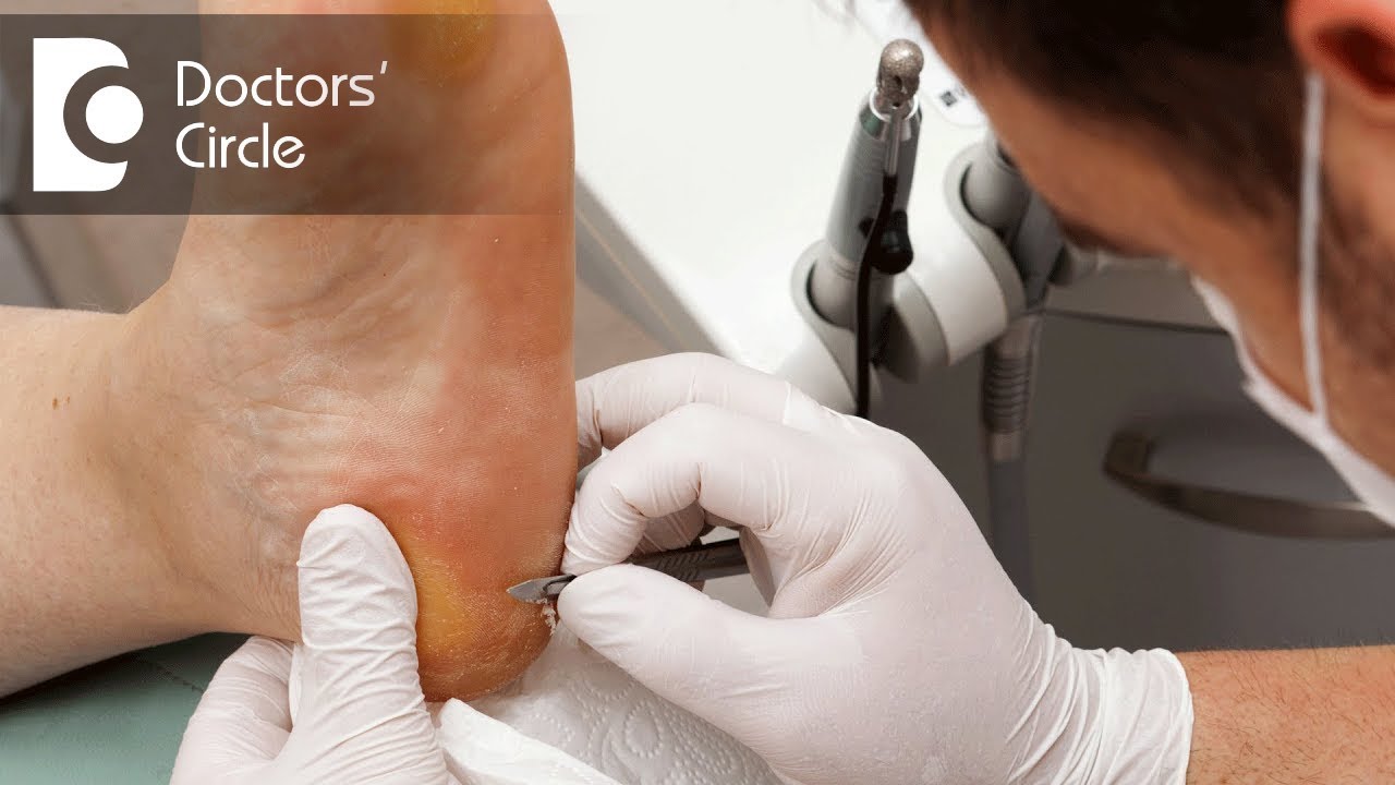 Types of non healing ulcers & treatment of Diabetic Foot Ulcer - Dr. Narendra Kumar Reddy