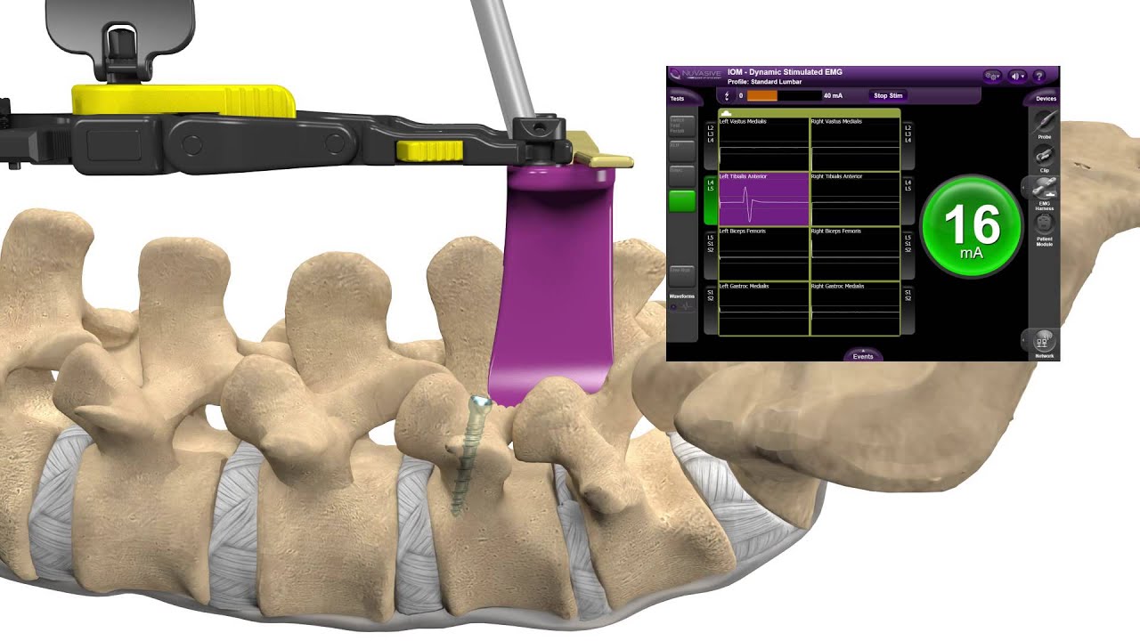 MAS® PLIF Patient Animation