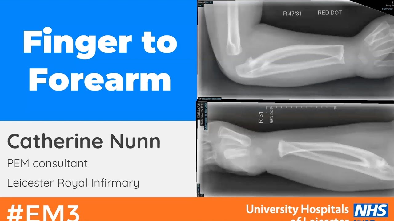 Paediatric Fingers to Forearms
