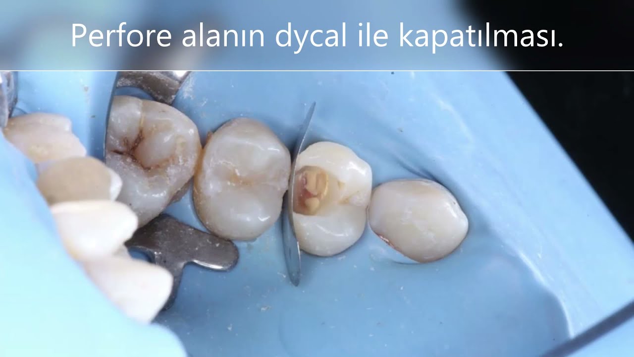 Posterior Direkt Restorasyon- Direkt Kuafaj Aşamaları