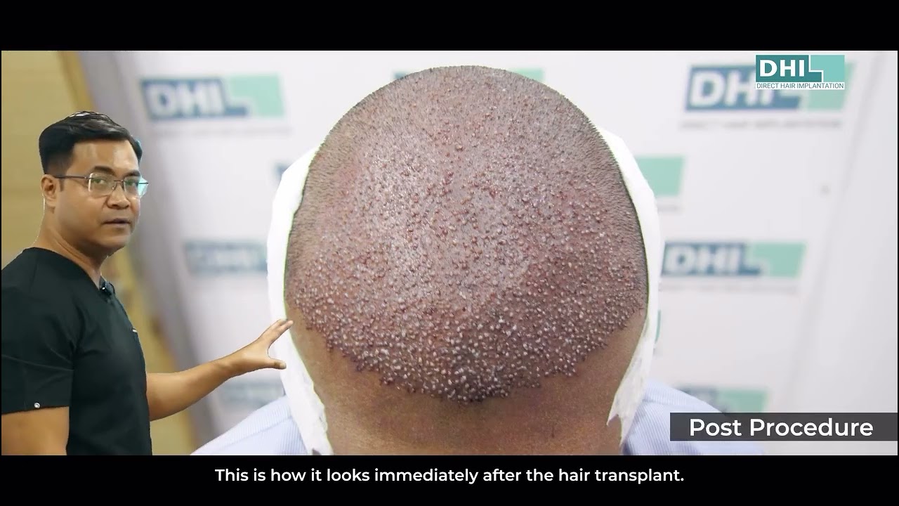 Hair transplant isn’t the finish line It’s day one of how you care for your new hair