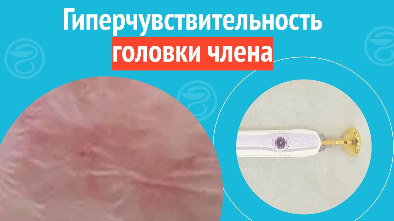 😮 Гиперчувствительность головки члена. Клинический случай №1301