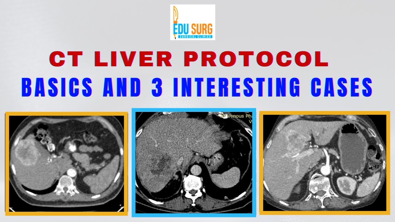 Liver CT - Protocol and Cases