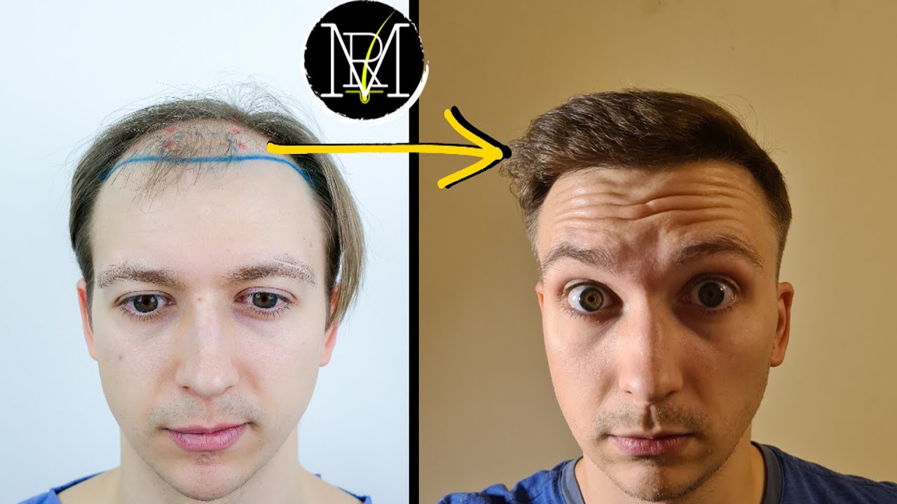 8.5 months after FUE Hair Transplant | 3500 grafts | Norwood 5a