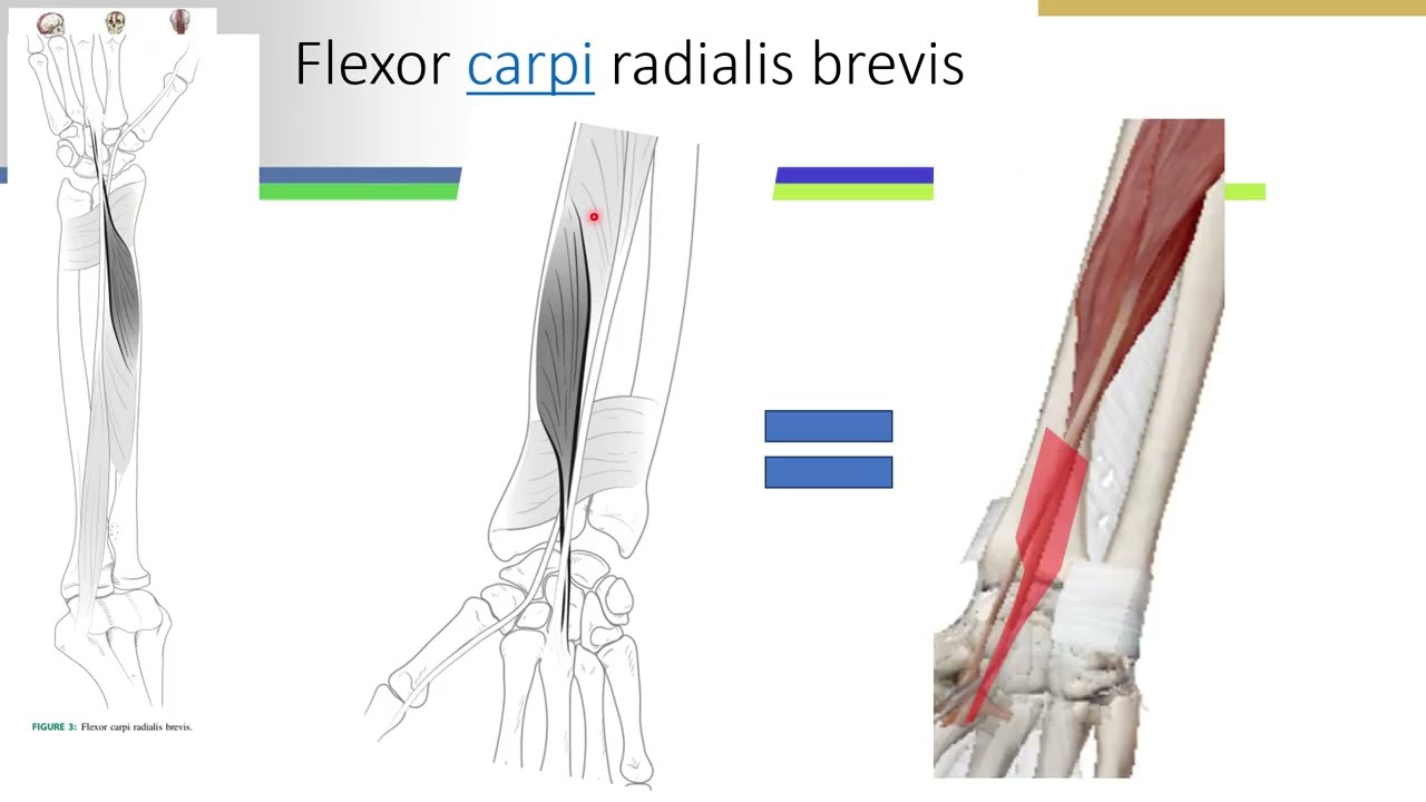 Flexor carpi radialis brevis: un muscle accessoire de l'avant bras
