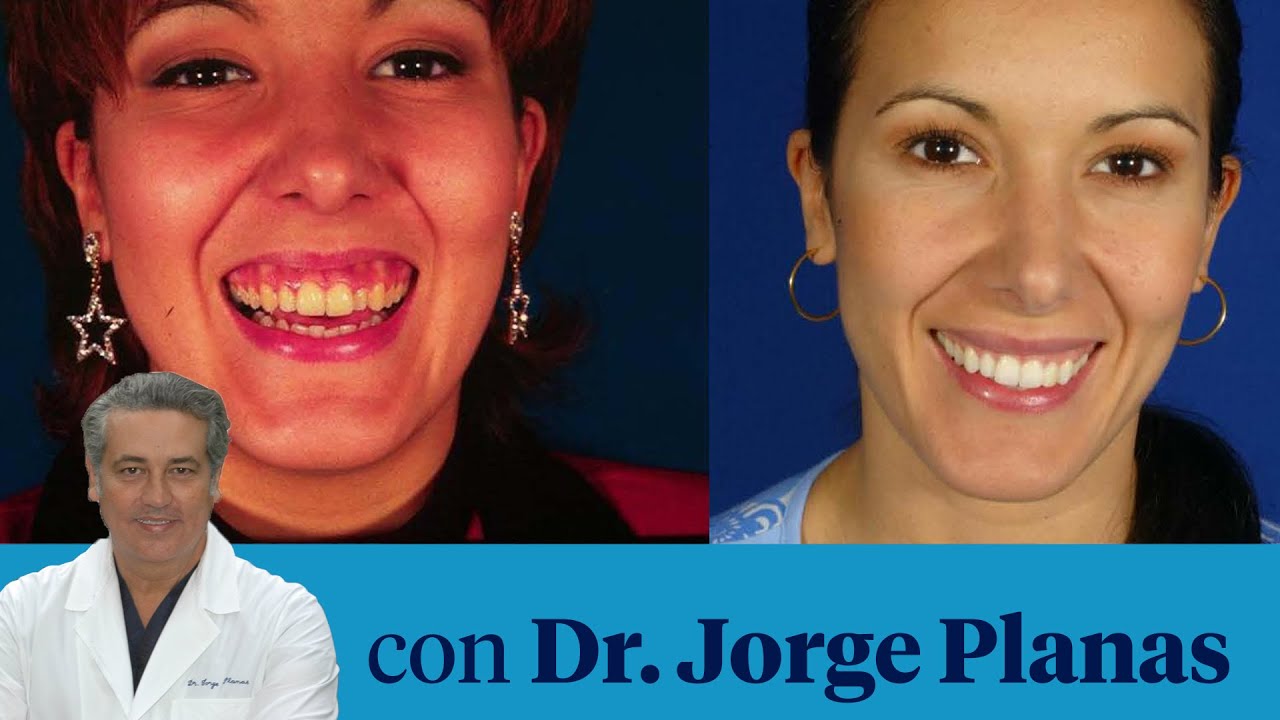 Cómo corregir la sonrisa Gingival