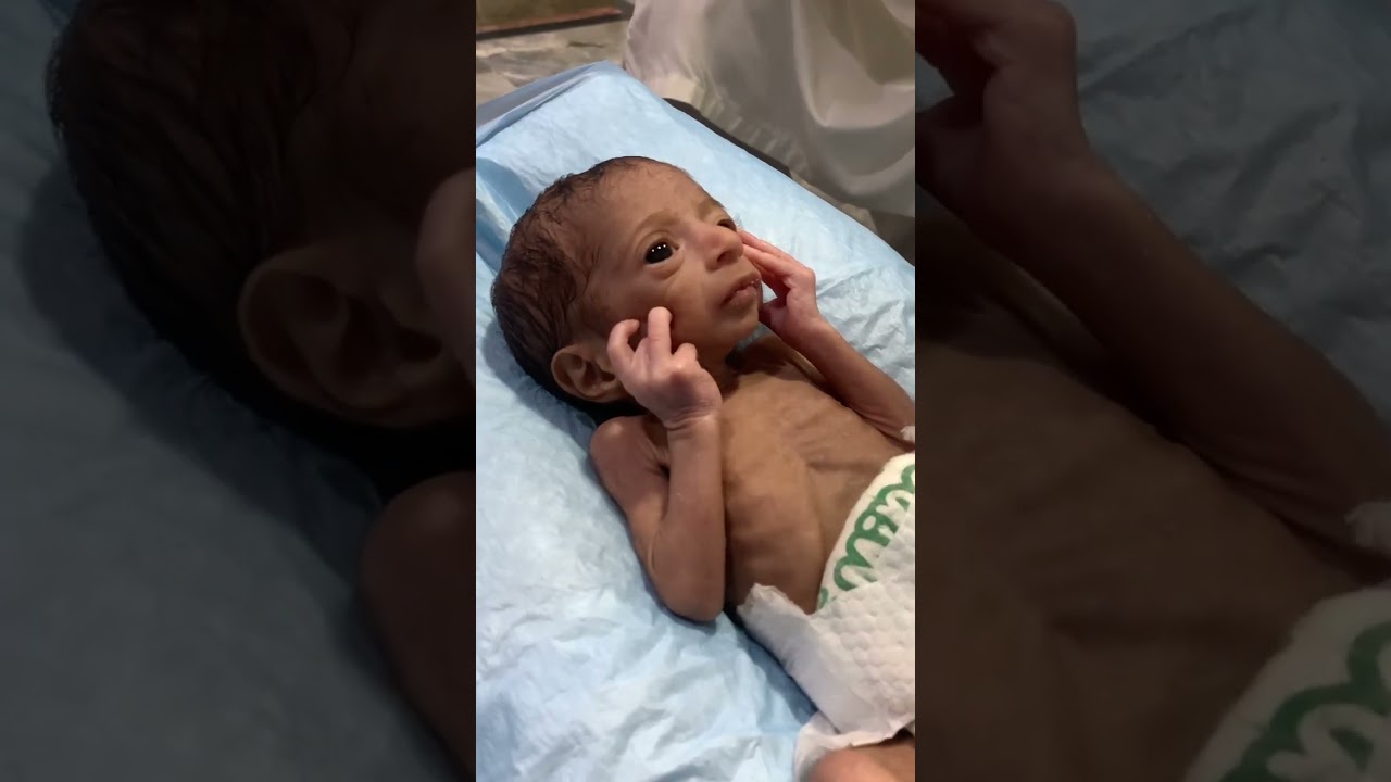 sever hungry #baby #baby #neonatologist #cuteanimal #newborn
