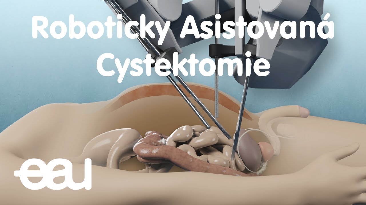 Roboticky Asistovaná Cystektomie (Czech)