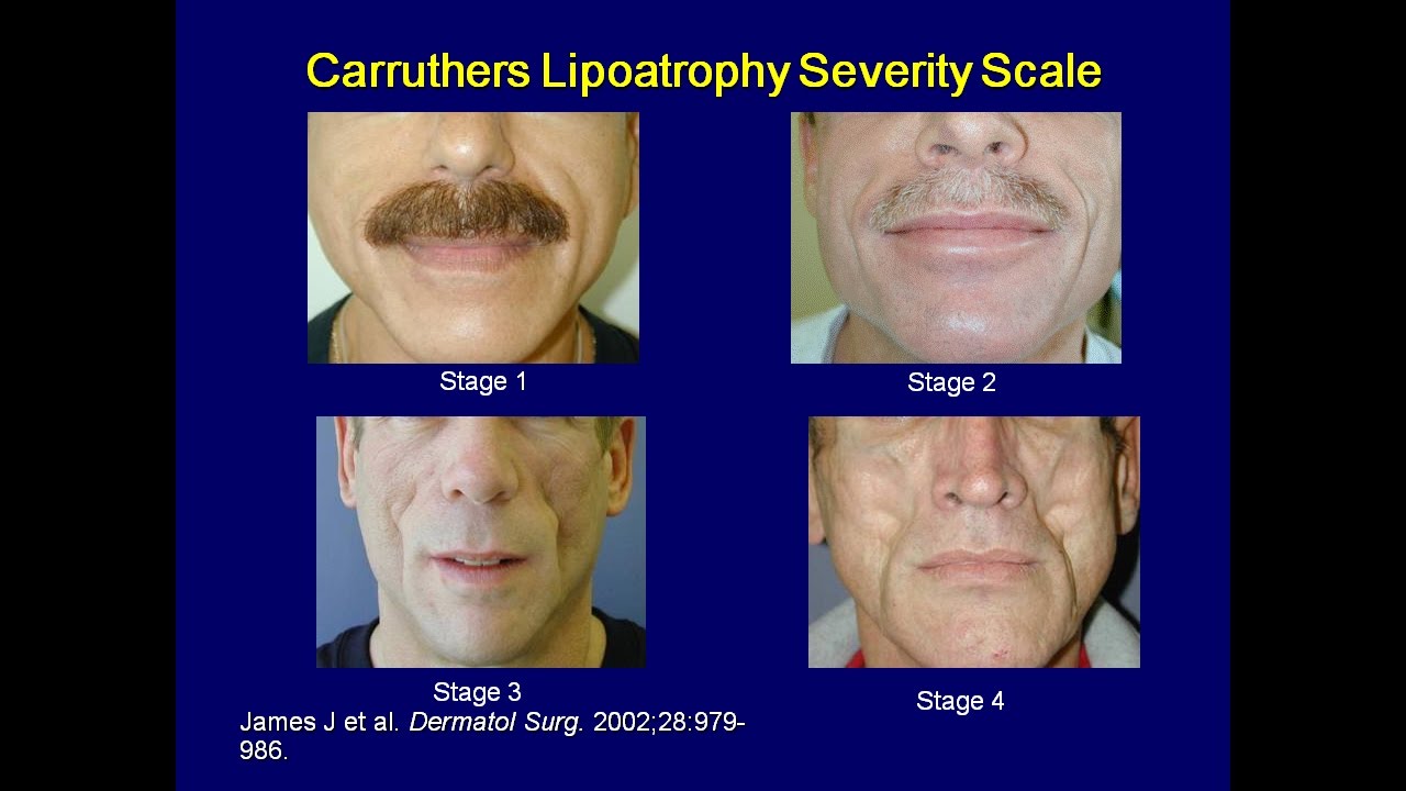 Interview with Dr Gerald Pierone About HIV Lipodystrophy Options