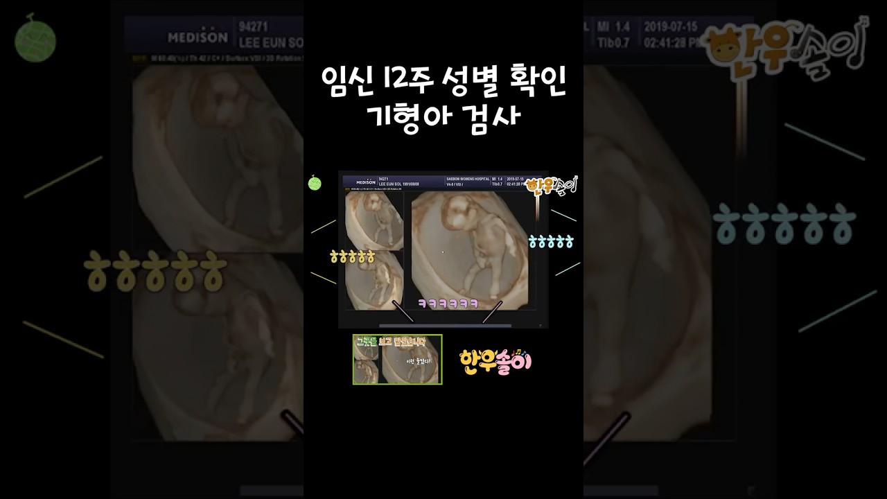 [임신 12주 4일]  성별 확인 및 기형아 검사 (아들?)