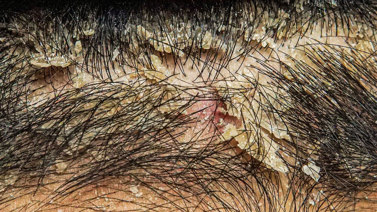 ASMR Satisfying Dandruff & Scalp Flakes Removal | Deep Comb Scratching #DMO3745