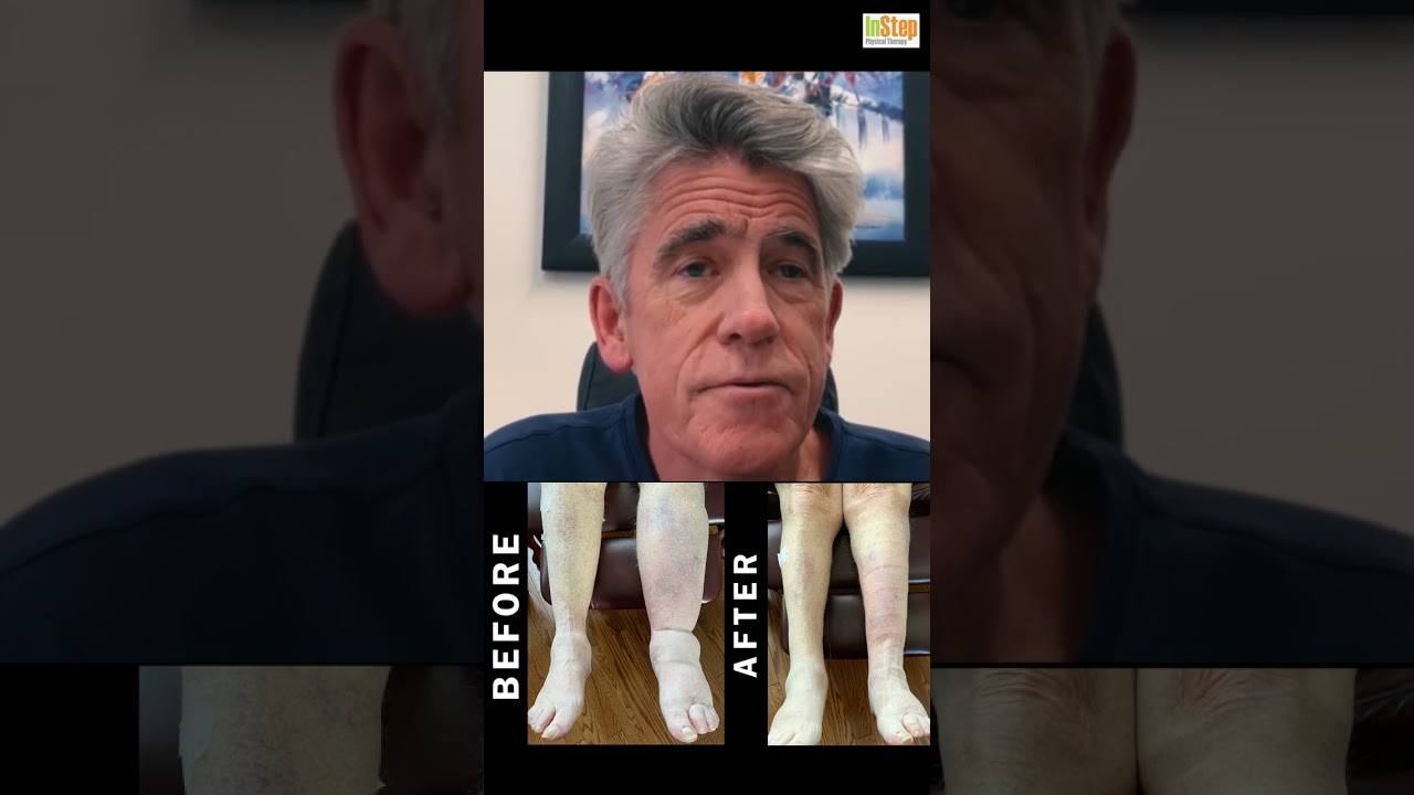Lymphedema Treatment: Ian Soles explains Intermittent Pneumatic Compression Device| InStep Edmonton
