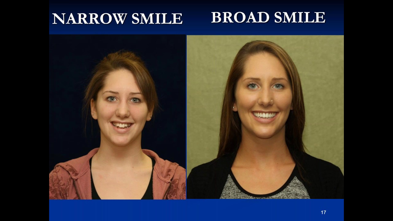 EARLY ORTHODONTIC TREATMENT