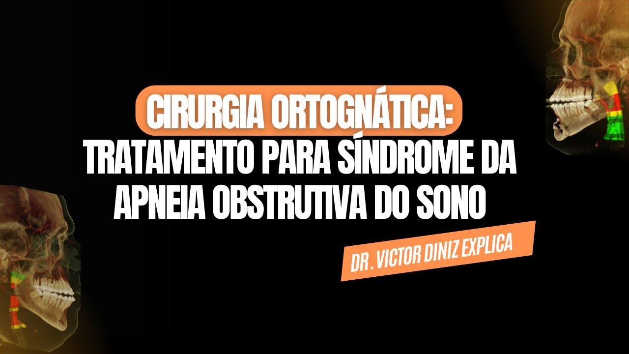 Tratamento da síndrome da apneia obstrutiva do sono com cirurgia ortognática. É realmente eficaz?