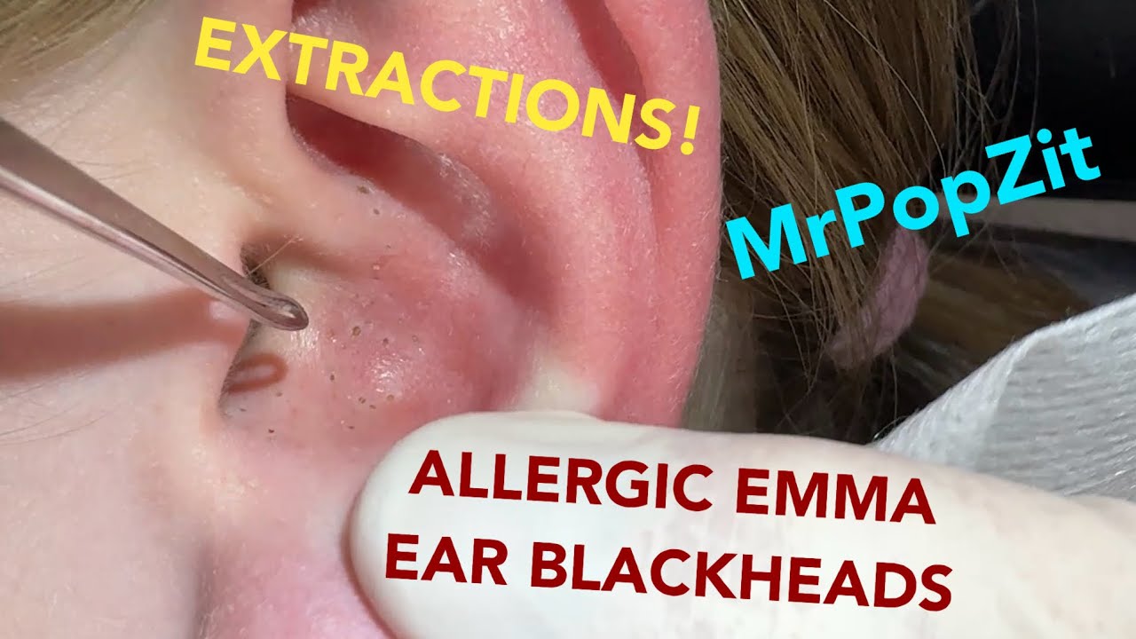 EAR BLACKHEAD EXTRACTIONS on a fellow YouTuber! Watch as I clear out her pores on her ear! 