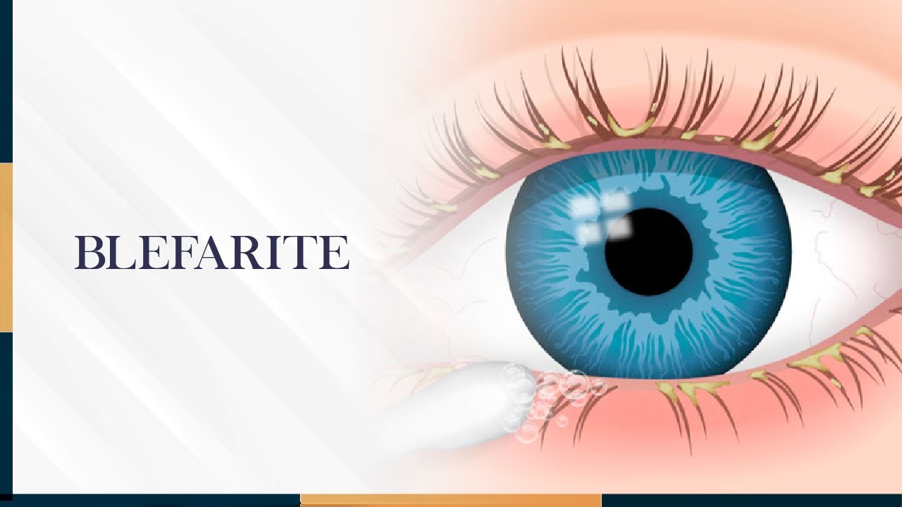 BLEFARITE TEM CURA?