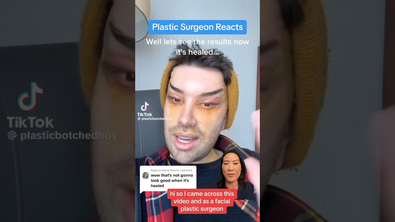 This Facelift GONE RIGHT?! (Surgeon Reacts)