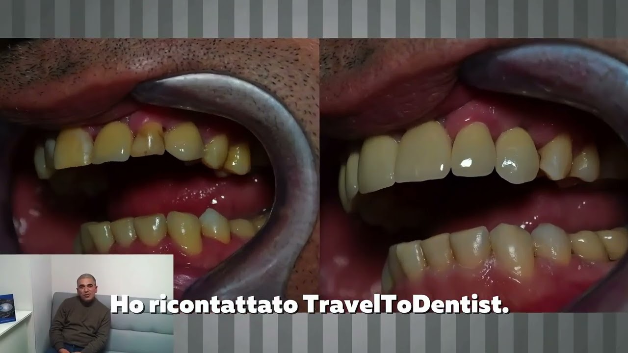 Impianti dentali in Moldavia: la storia di Adriano tra errore e rinascita