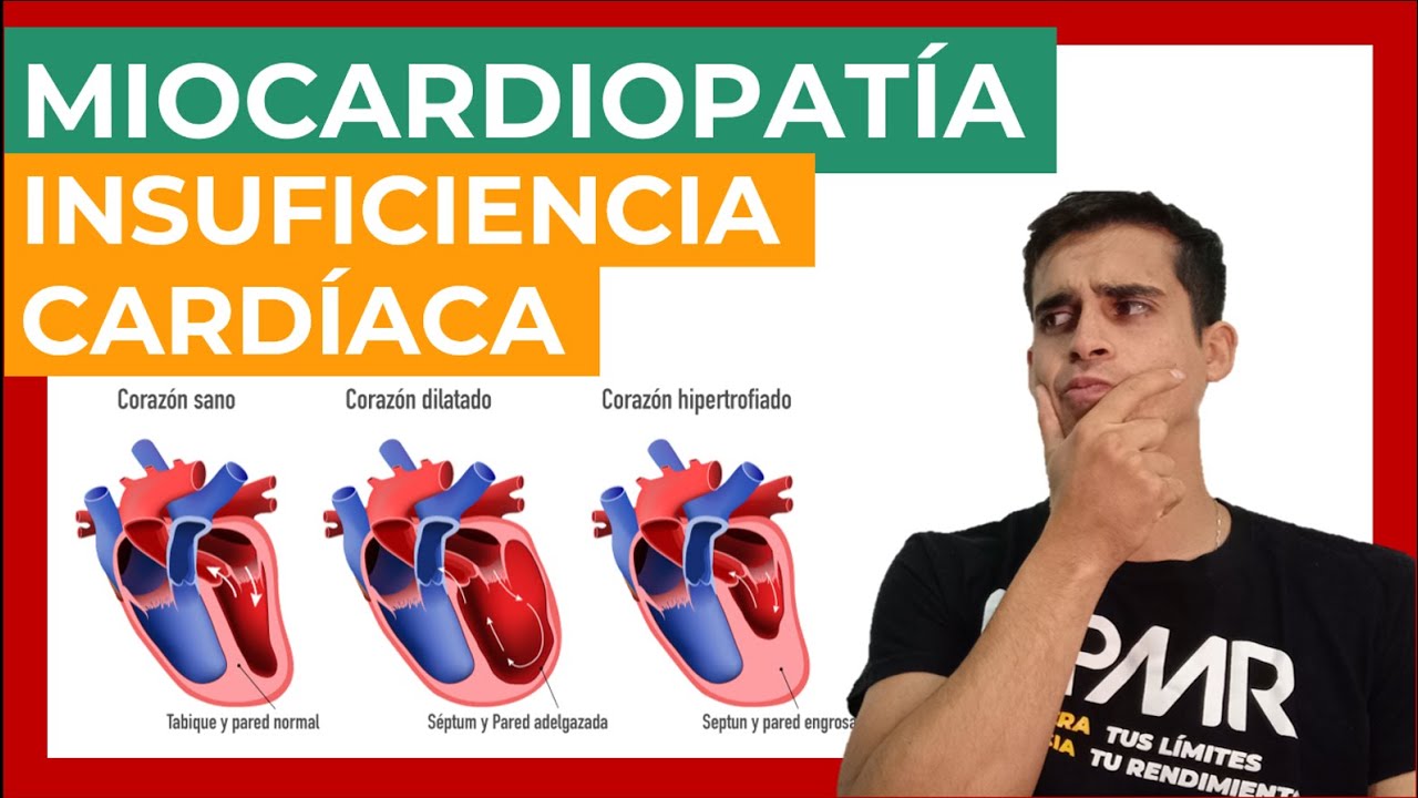 🩺 MIOCARDIOPATIA E INSUFICIENCIA CARDÍACA