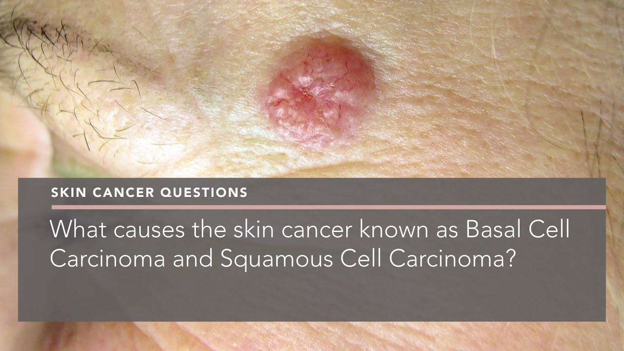 What causes the skin cancer known as Basal Cell Carcinoma and Squamous Cell Carcinoma?