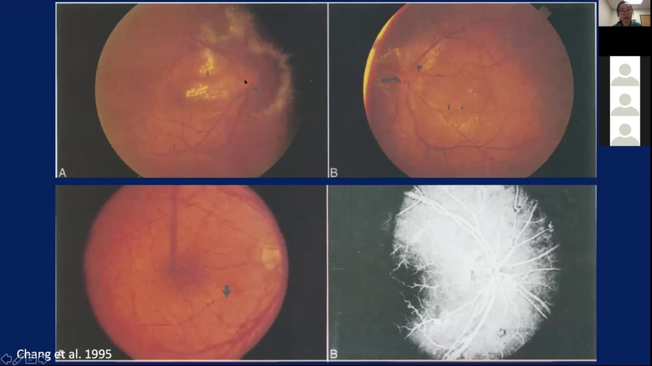 CU Department of Ophthalmology Grand Rounds 4/3/2020 - Drs. Chen, Mudie, & Reddy