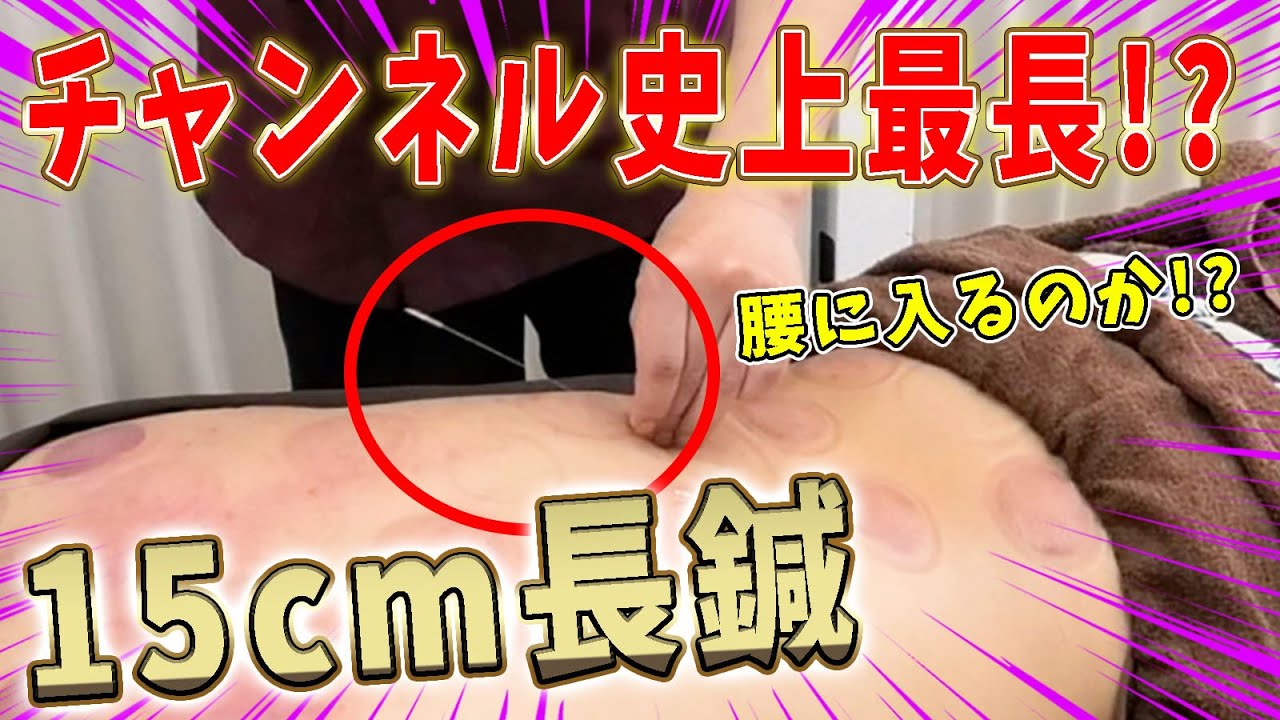 【吸い玉】吸い玉後に最長の鍼！なんと15cm！これが腰に入るのか...！？【@uwasa-no-canna 】