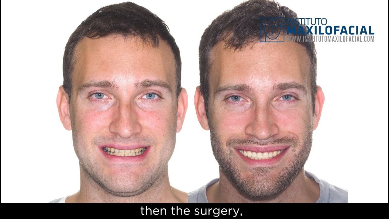 Jaw surgery Case # 107: Jean-Paul - Class III bite, maxillary hypoplasia, lateral open bite