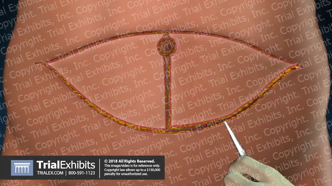 Bilateral Breast Reconstruction with Pedicle TRAM Flaps