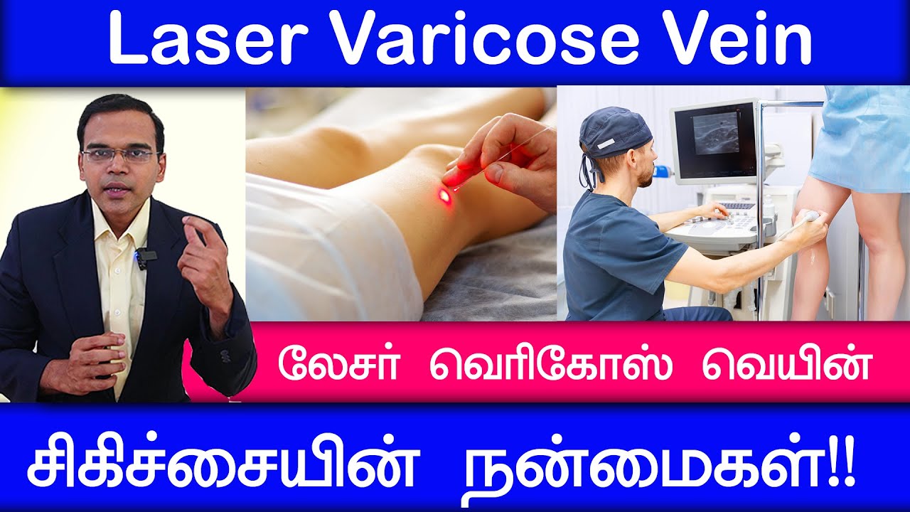 லேசர் வெரிகோஸ் வெயின் சிகிச்சையின் நன்மைகள்!! Laser Varicose Vein Explain  With Dr.Ashok