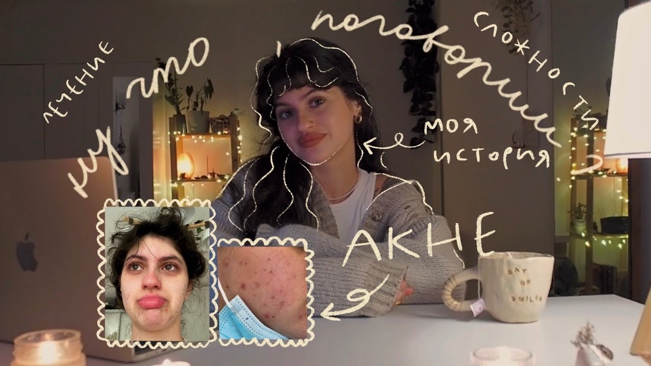 История моей кожи ♡ борьба с акне• ненависть к себе • безысходность и лечение