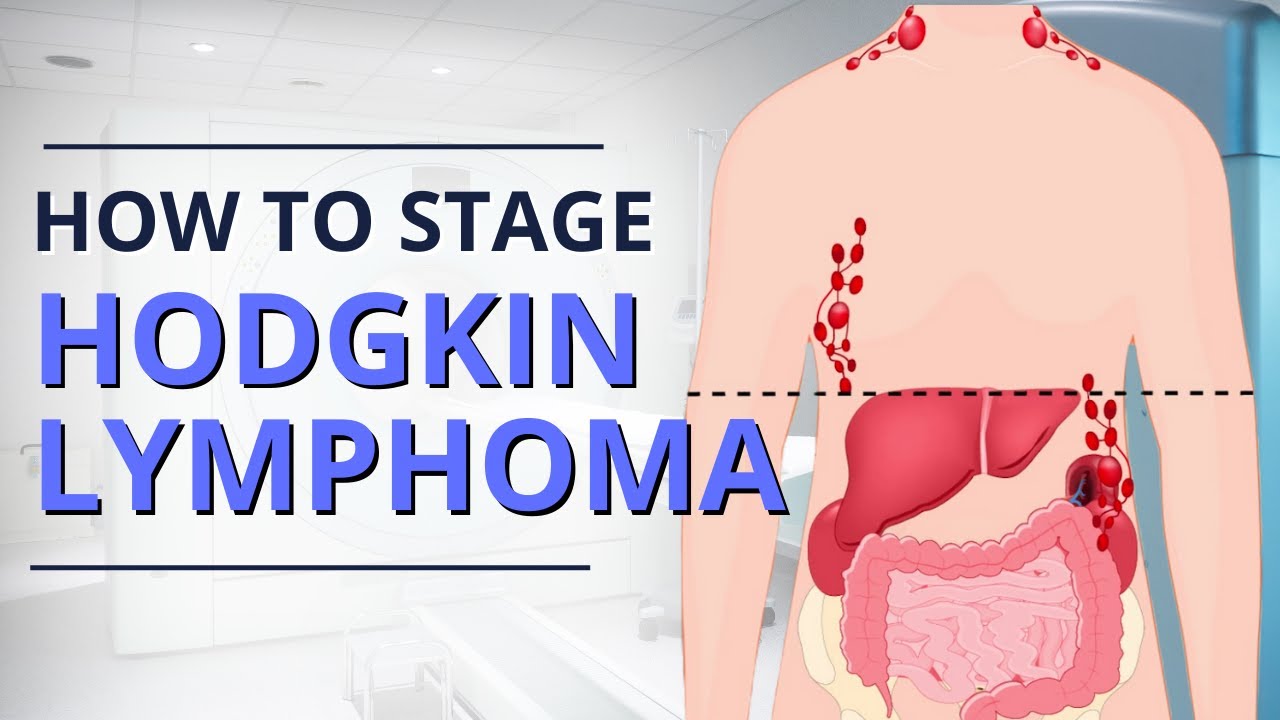 Hodgkin Lymphoma Staging: From Diagnosis to Prognosis | The Patient Story