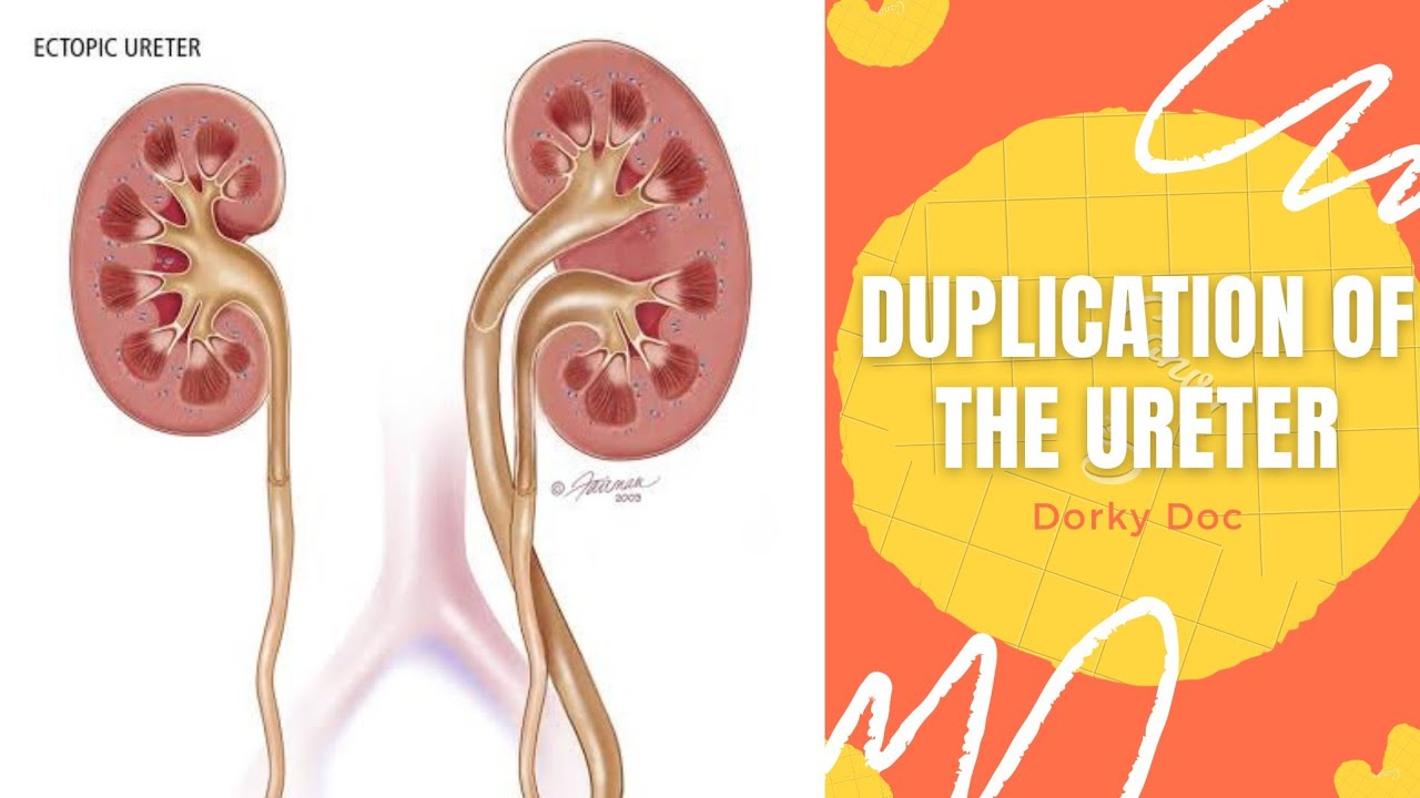 Duplication Of The Ureter | Congenital anomaly of the kidney Part- 1 | Dorky Doc.