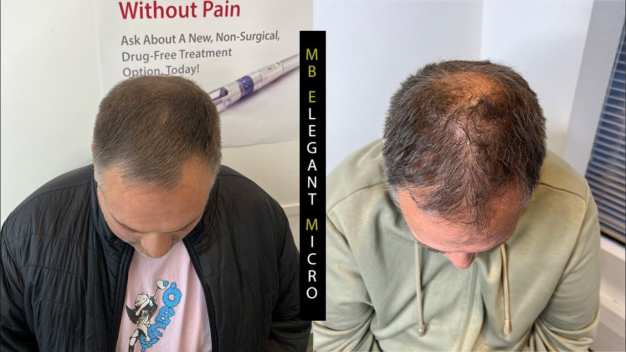Scalp Micropigmentation - hair density increase