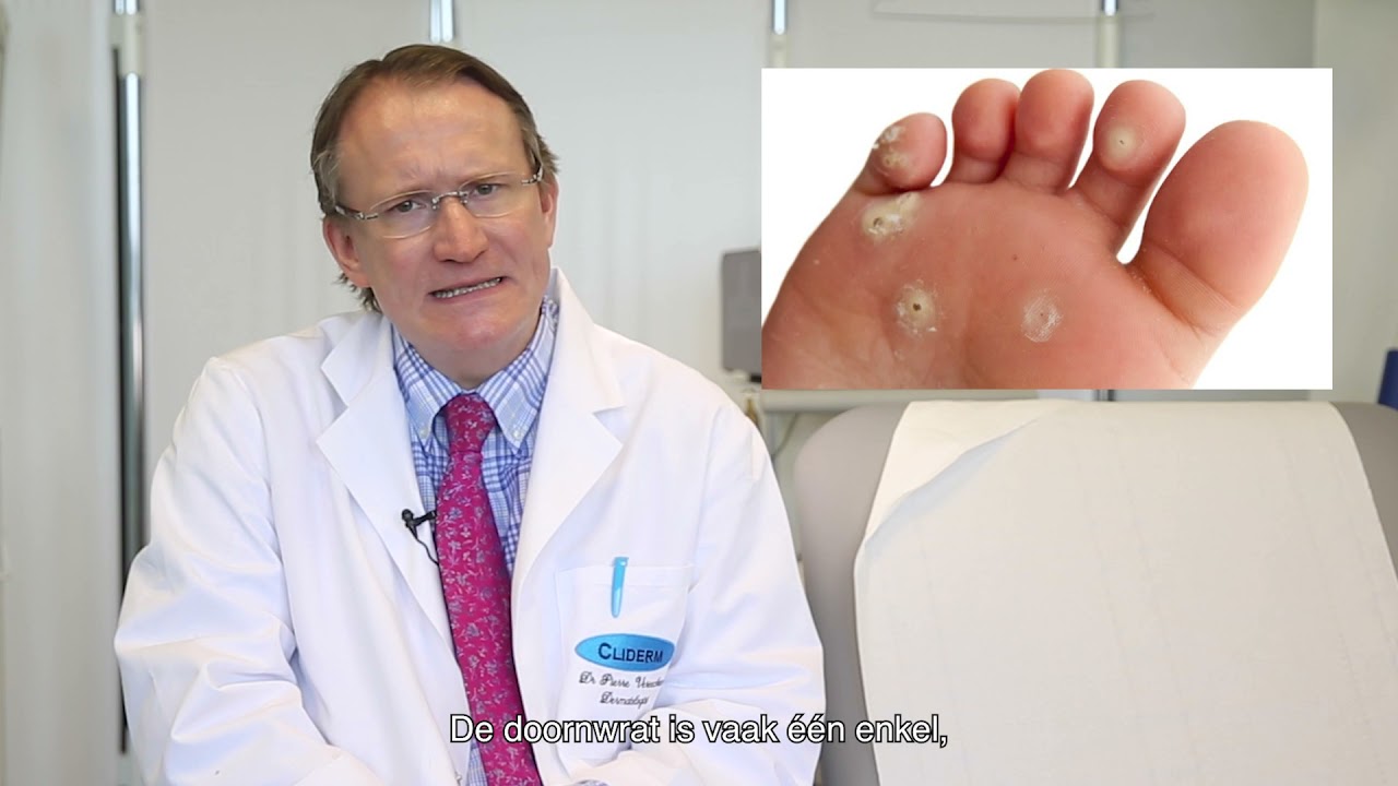 Cliderm: Wratten - Hoe ziet een wrat eruit?