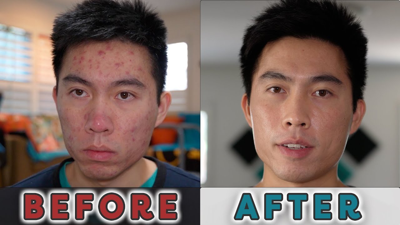 My Accutane Journey - Everything I Learned Along the Way