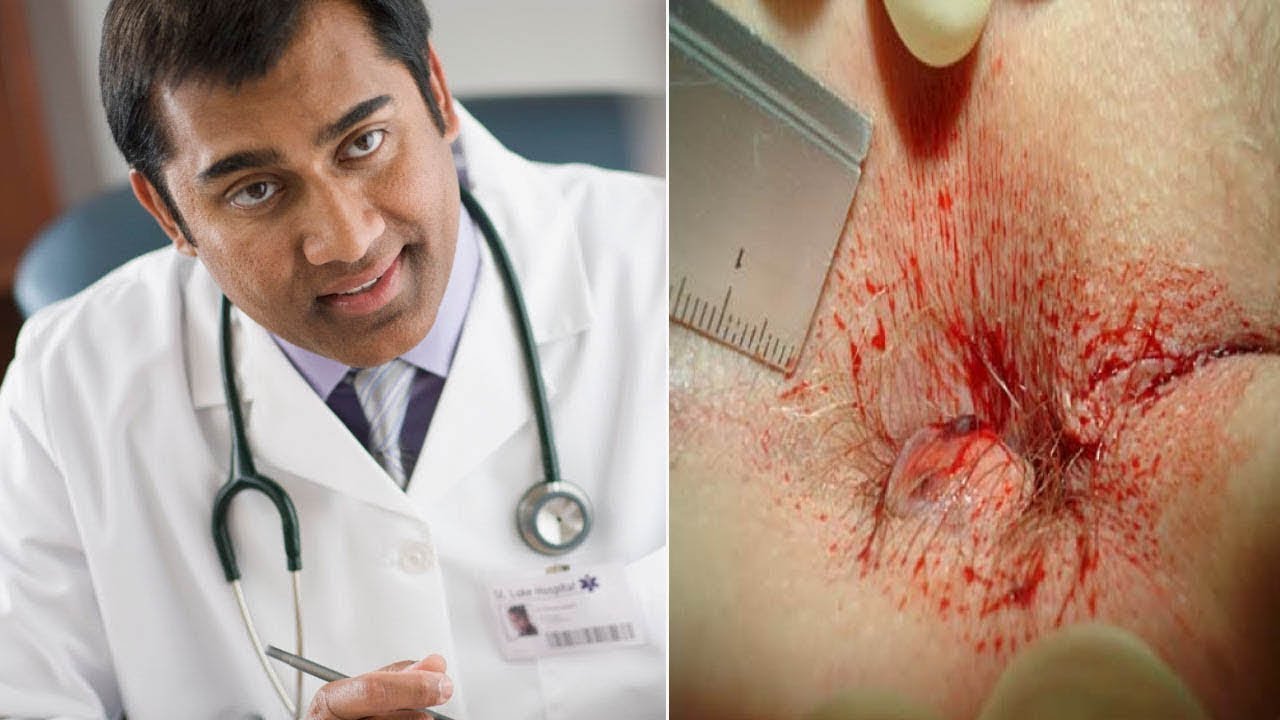Doctor Approved Advice on How to Stop Bleeding Hemorrhoids