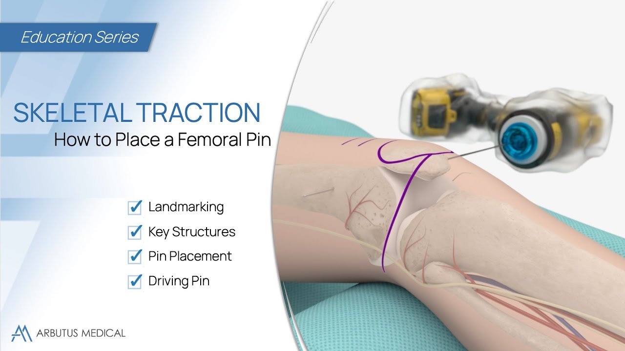 How to Place a Femoral Pin - Skeletal Traction Animation